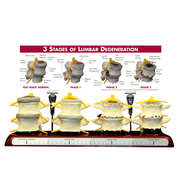 3D Spine Degeneration Model (Quantity: 1)